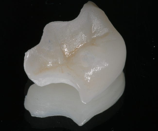 An Emax Porcelain Onlay
