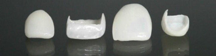 Porcelain Veneers