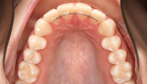Fixed Orthodontic Retainers fitted once orthodontic treatment has been completed