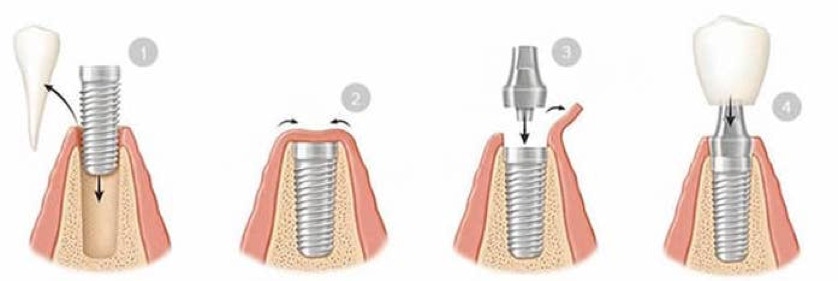 Summary of the Dental Implant Process 