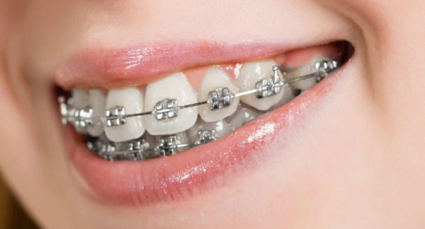 Fixed (Train Tracks) Orthodontic Braces
