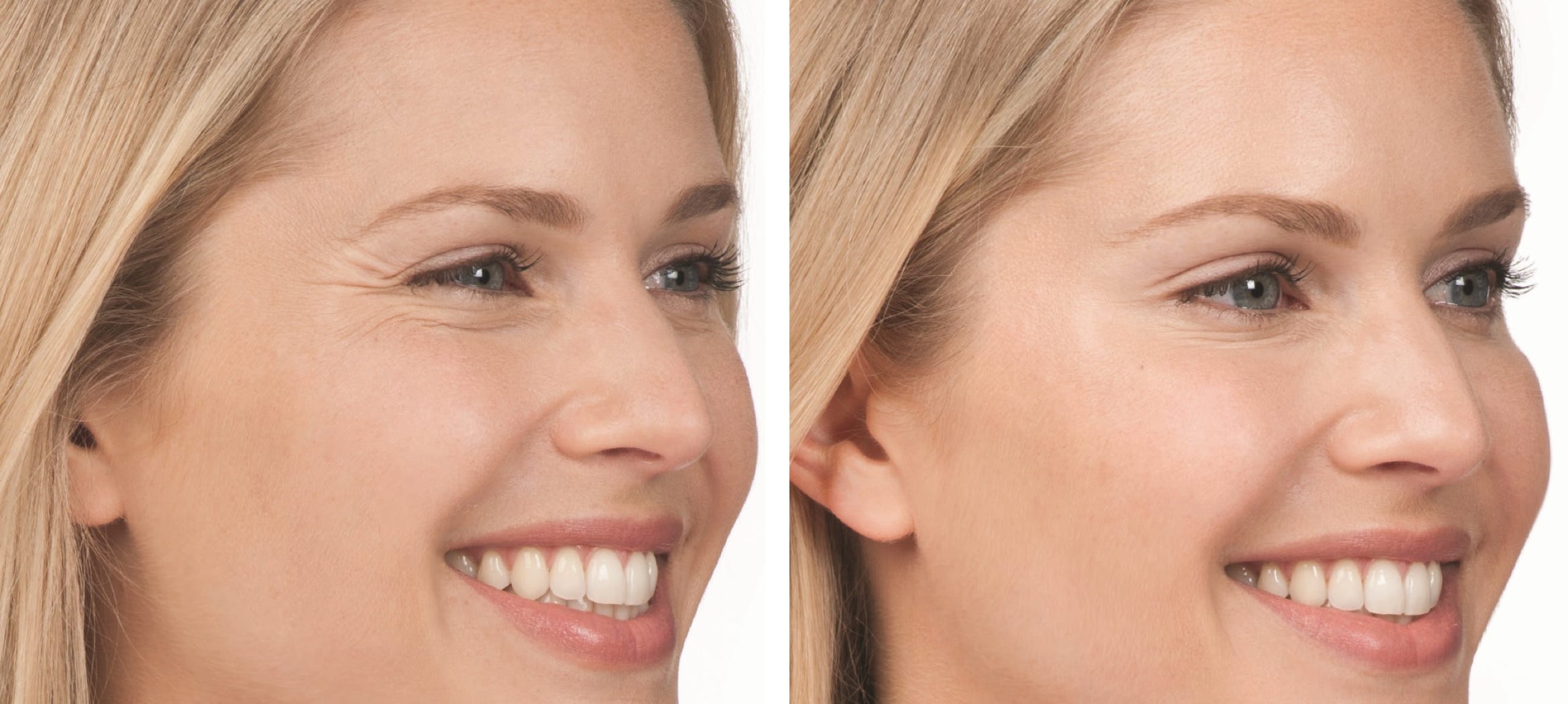 Before and after botox treatment