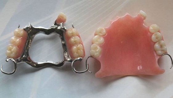 A Comparison of a Cobalt-Chrome Denture and a Partial Acrylic Denture 